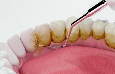 teeth cleaning procedure at Molars Dental Nairobi – affordable dental full mouth scaling Kenya